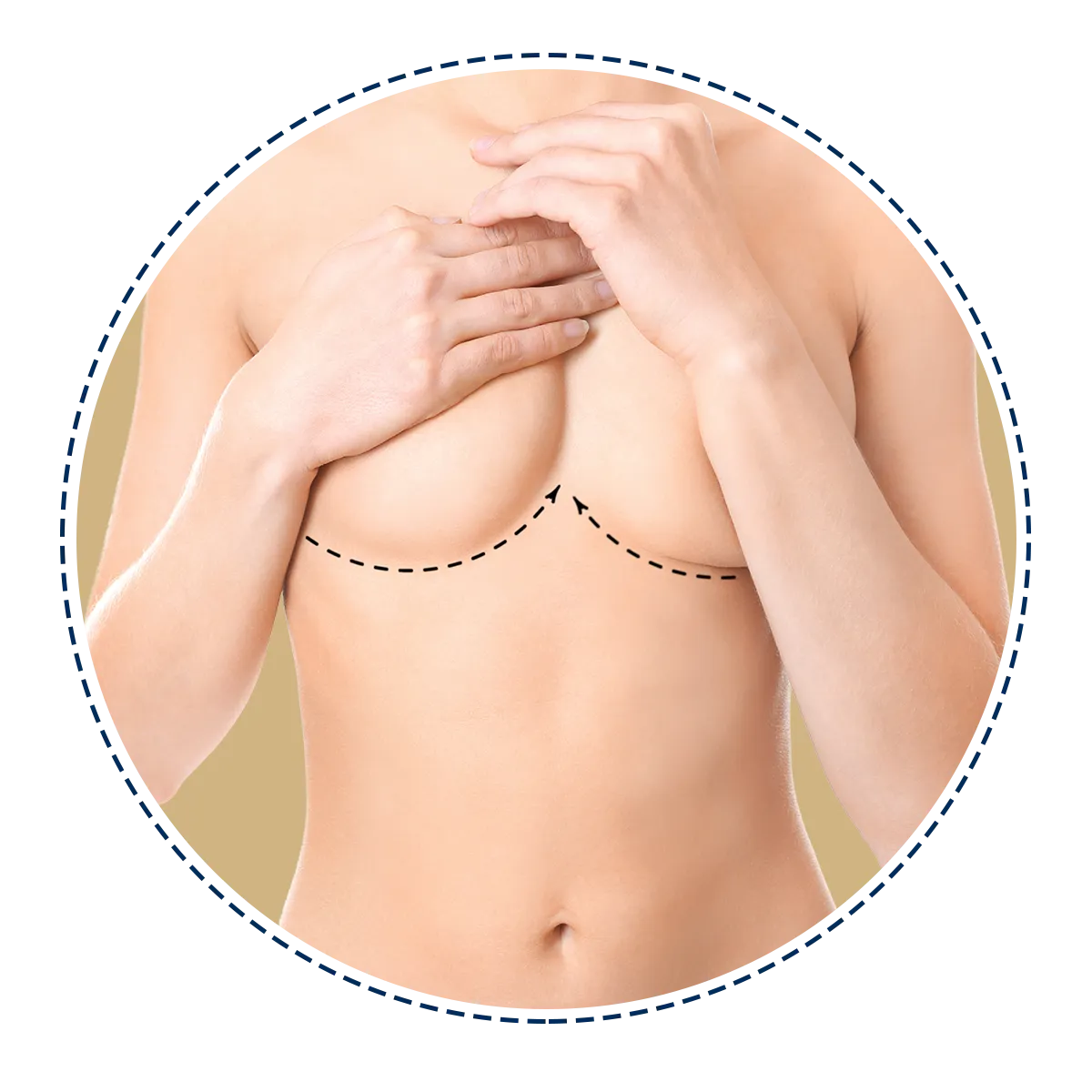 Correcting sagging breasts | Milada Plastic Surgery Hospital 